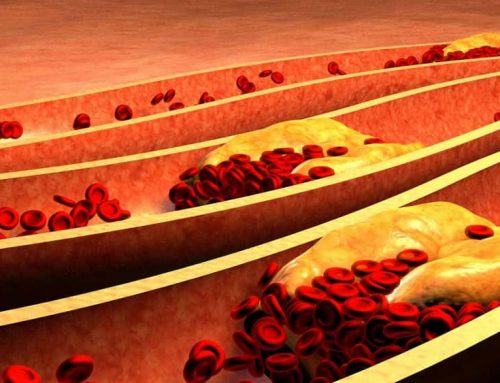 Colesterolo alto: un disagio metabolico risolvibile
